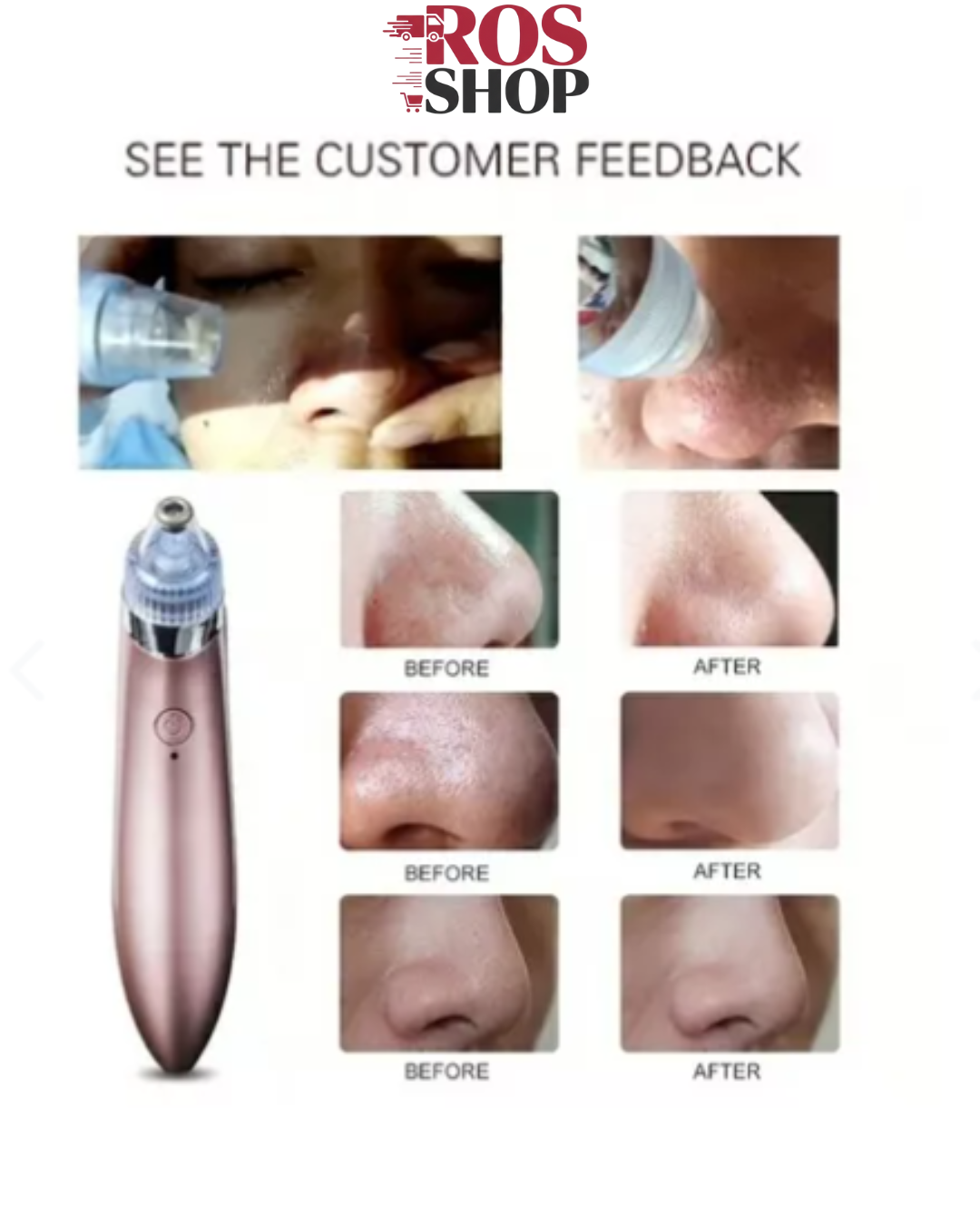 Extractor Removedor De Puntos Negros